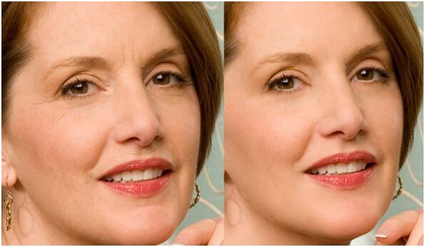 przed i po plazmowym odmładzaniu skóry twarzy