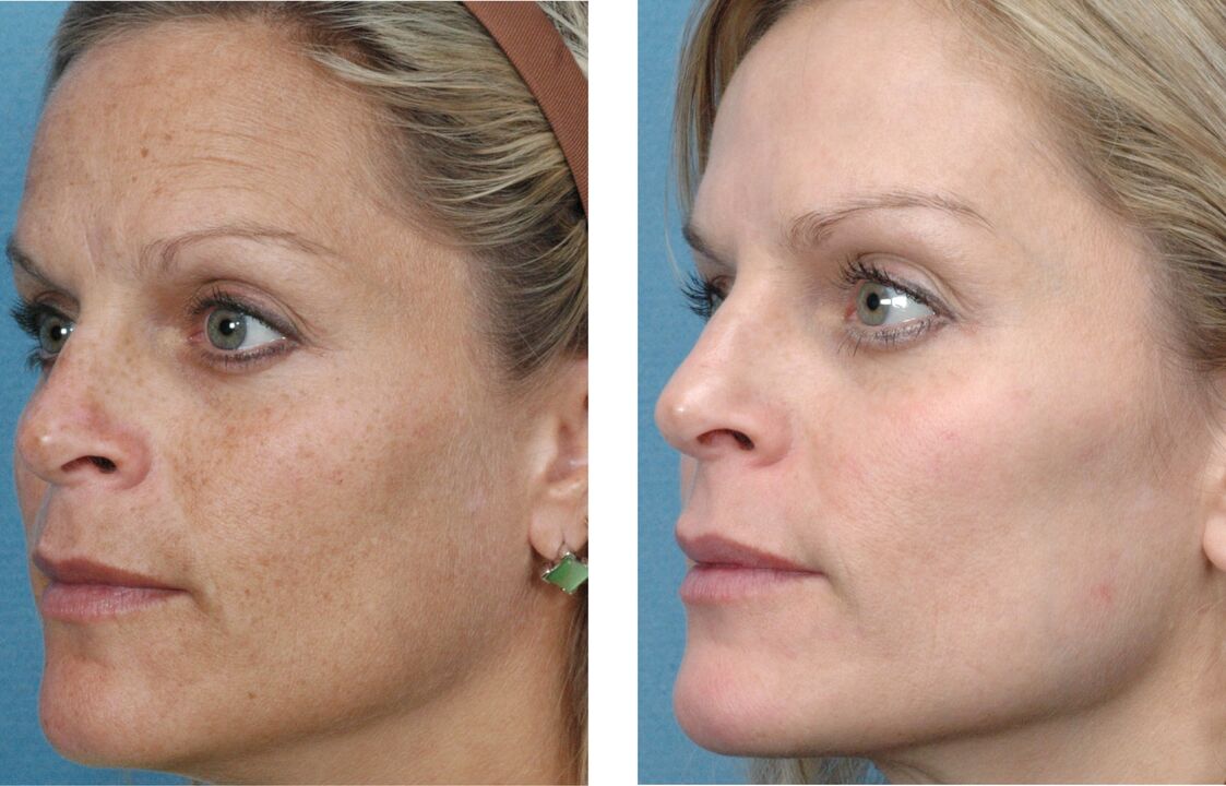 przed i po odmładzaniu skóry zdjęcie 1