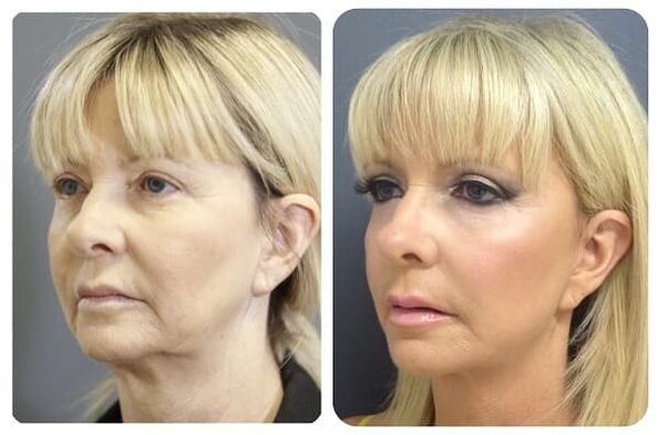 przed i po odmładzaniu skóry z napinaniem fot. 2
