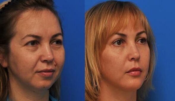 przed i po odmładzaniu skóry z napinaniem zdjęcie 1
