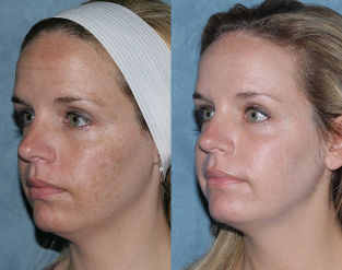 Zdjęcia przed i po częściowej odmładzania twarzy