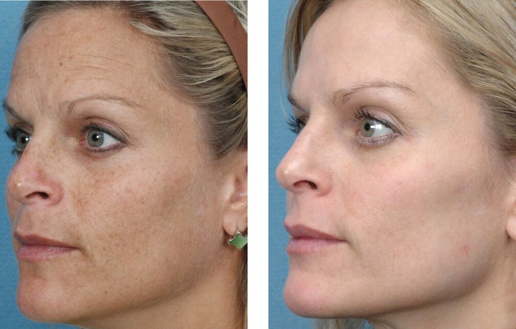 przed i po odmładzaniu skóry twarzy