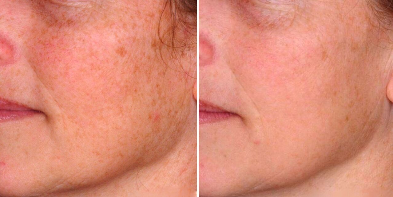 Efektem fototermolizy frakcyjnej jest redukcja plam starczych na skórze twarzy. 
