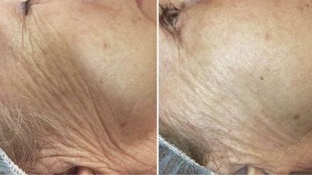 przed i po laserowym odmładzaniu skóry