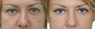Zdjęcia przed i po konturowaniu powieki